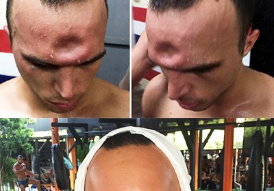 Травма головы Джереми 